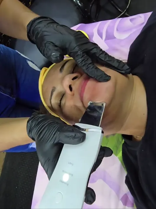Práctica de dermaplaning con espátula ultrasónica